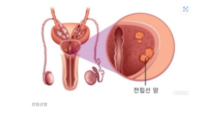 전립선과 전립선암의 모습