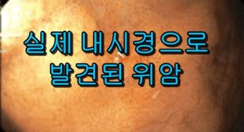 실제 내시경으로 발견한 위암의 모습과 오진 위험